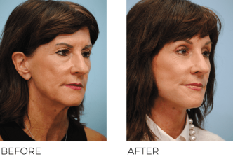 65-74 Year Old Woman Treated with Facelift 1 Month Post-Op
