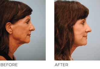 65-74 Year Old Woman Treated with Facelift 1 Month Post-Op