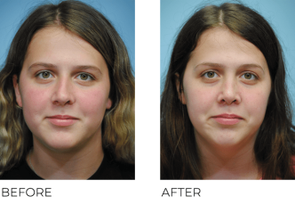 18-24 Year Old Woman Treated with Rhinoplasty 1 Year Post-Op