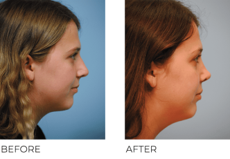 18-24 Year Old Woman Treated with Rhinoplasty 1 Year Post-Op