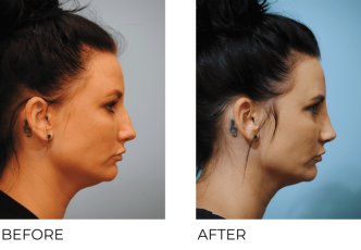 35-44 year old woman treated with Rhinoplasty 1 Month Post-Op