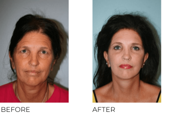 65-74 Year Old Woman Treated with Facelift, Blepharoplasty and Endoscopic Brow Lifting 6 Months Post-Op