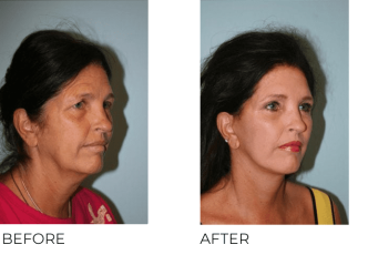 65-74 Year Old Woman Treated with Facelift, Blepharoplasty and Endoscopic Brow Lifting 6 Months Post-Op