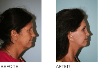 65-74 Year Old Woman Treated with Facelift, Blepharoplasty and Endoscopic Brow Lifting 6 Months Post-Op