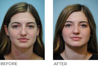 18-24 year old woman treated with Rhinoplasty 6 months postop