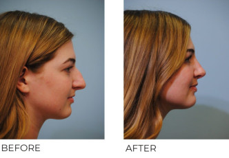 18-24 year old woman treated with Rhinoplasty 6 months postop