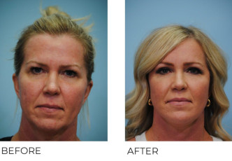 45-54 Year Old Woman Treated with Facelift 6 Months Post-Op