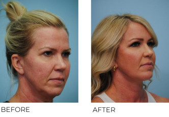 45-54 Year Old Woman Treated with Facelift 6 Months Post-Op