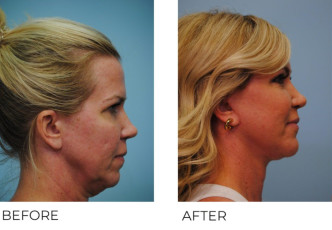 45-54 Year Old Woman Treated with Facelift 6 Months Post-Op