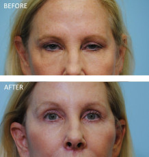 55-64 year old woman treated for ptosis repair 3 months postop a
