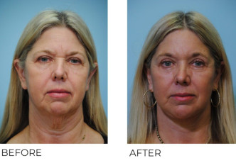 55-64 year old woman treated with Facelift 3 month postop A