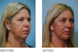 55-64 year old woman treated with Facelift 3 month postop B