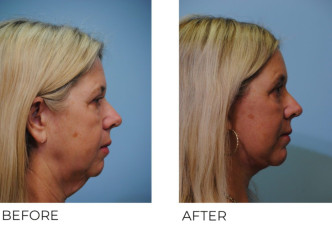 55-64 year old woman treated with Facelift 3 month postop C