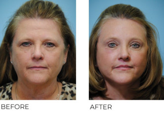 55-64 year old woman treated with Facelift 6 months postop