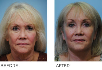 55-64 year old woman treated with Facelift 6 months postop