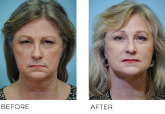 55-64 year old woman treated with Facelift 6 months postop