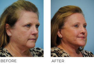 55-64 year old woman treated with Facelift 6 months postop
