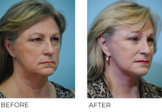 55-64 year old woman treated with Facelift 6 months postop