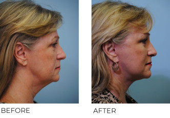 55-64 year old woman treated with Facelift 6 months postopC