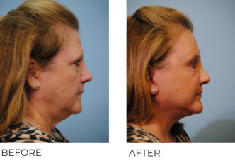 55-64 year old woman treated with Facelift 6 months postop