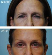 55-64 year old woman treated with Ptosis Repair 1 month postop