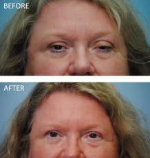 55-64 year old woman treated with Ptosis Repair 6 months postop