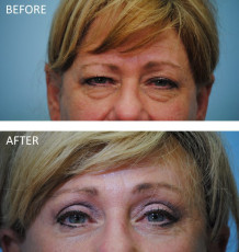 55-64 year old woman treated with ptosis repair postop 6 months
