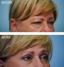 55-64 year old woman treated with ptosis repair postop 6 months