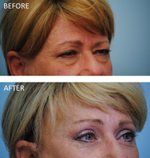55-64 year old woman treated with ptosis repair postop 6 months