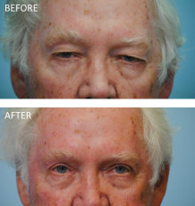 65-74 year old man treated with Browlift and Blephs 6 months postop