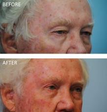 65-74 year old man treated with Browlift and Blephs 6 months postop