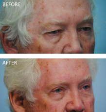 65-74 year old man treated with Browlift and Blephs 6 months postop