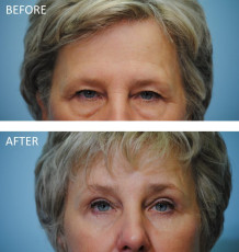 65-74 year old woman treated with Browlift and Blephs 6 months postop