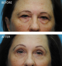 65-74 year old woman treated with Browlift and Blephs 6 months postop