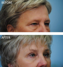 65-74 year old woman treated with Browlift and Blephs 6 months postop