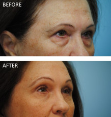 65-74 year old woman treated with Browlift and Blephs 6 months postop