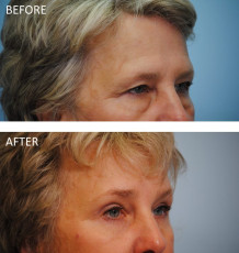 65-74 year old woman treated with Browlift and Blephs 6 months postop