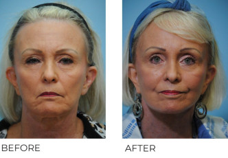 65-74 year old woman treated with Facelift 6 months postop