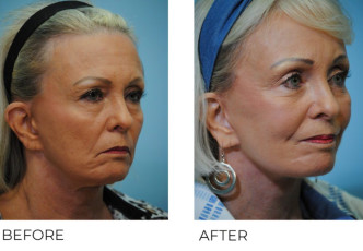 65-74 year old woman treated with Facelift 6 months postop