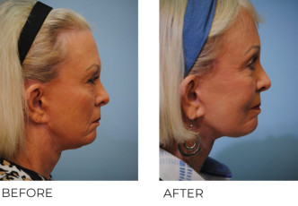 65-74 year old woman treated with Facelift 6 months postop