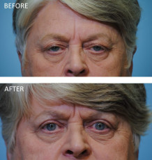 65-74 year old woman treated with Ptosis Repair 3 months postop