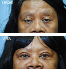 65-74 year old woman treated with Ptosis Repair 6 months postop
