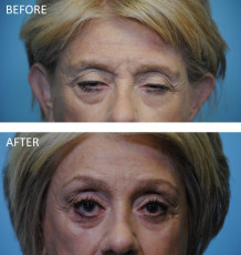65-74 year old woman treated with Ptosis Repair postop 6 months