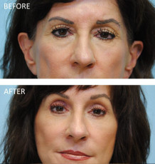 65-74 year old woman treated with ptosis repair 6 months postop