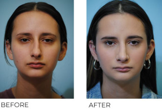 18-24 year old woman treated with Rhinoplasty 6 months postop A