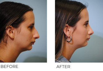 18-24 year old woman treated with Rhinoplasty 6 months postop B