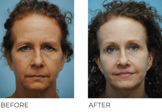 45-54 Year Old Woman Treated with Facelift 3 Months Post-Op