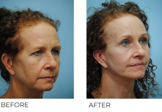 45-54 Year Old Woman Treated with Facelift 3 Months Post-Op