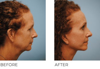 45-54 Year Old Woman Treated with Facelift 3 Months Post-Op