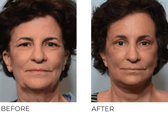 64 year old women treated with Facelift, endobrow with tines, cervical liposuction, bilateral upper blephs, cortex CO2, 1 month post op